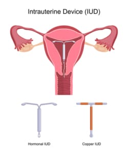 Kupferspirale oder Hormonspirale